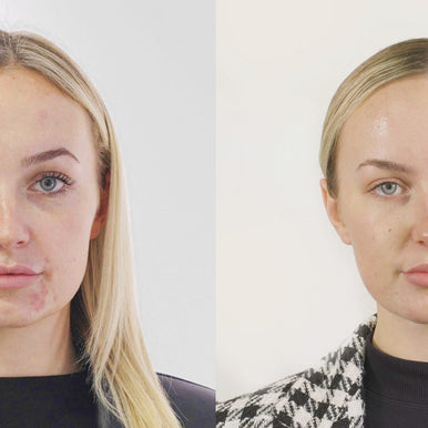 The Ultimate Skin Synergy: VITARAN Polynucleotides & Seventy Hyal 2000