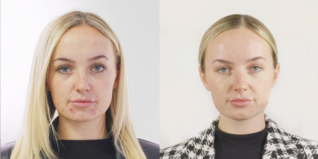 The Ultimate Glow: Seventy Hyal 2000 Skin Booster