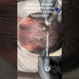 INBIOHAIR Treatment